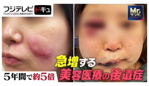 【Mr.サンデー】脂肪吸引直後に意識不明で救急搬送！急増する美容医療“後遺症”の実態【実録ドキュメント】