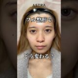 フル整形どう変わる？😘#astrabeautyclinic  #アストラビューティークリニック #塩満恵子 #鼻整形 #美容整形 #忘れ鼻