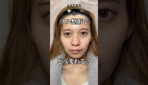 フル整形どう変わる？😘#astrabeautyclinic  #アストラビューティークリニック #塩満恵子 #鼻整形 #美容整形 #忘れ鼻