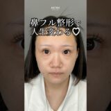 【人生が変わる鼻整形♡#astrabeautyclinic #塩満恵子#鼻整形#忘れ鼻#美容整形】