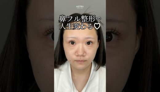 【人生が変わる鼻整形♡#astrabeautyclinic #塩満恵子#鼻整形#忘れ鼻#美容整形】