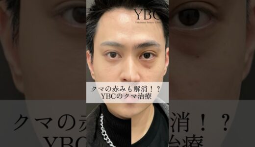 男性にも大人気クマ治療#美容 #美容整形 #イソセン#ybc横浜美容外科 #目の下のたるみ取り #目の下のクマ #若返り