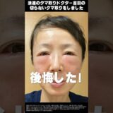 クマ取りしたら後悔した【ダウンタイム経過あり】50代の若返り日記