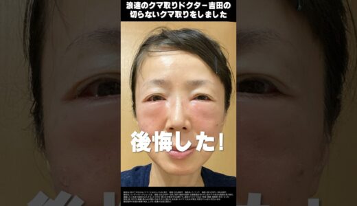 クマ取りしたら後悔した【ダウンタイム経過あり】50代の若返り日記
