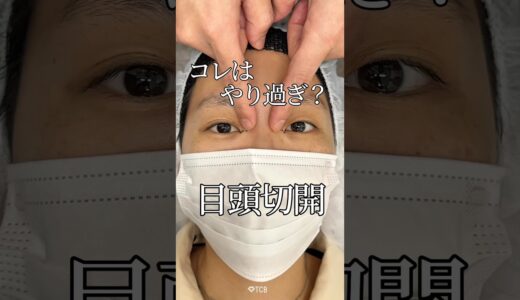 【二重整形】コレはやり過ぎ？目頭切開#shorts