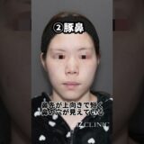 【鼻整形】あなたの鼻はどのタイプ？#shorts