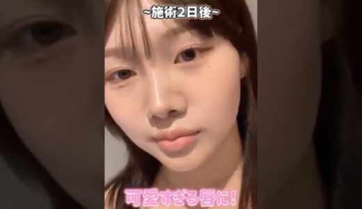 韓国美容整形クリニック「リンク美容外科」唇ヒアルのリアルレポ　#韓国美容 #韓国整形 #美容整形 #美容垢 #整形垢 #韓国旅行