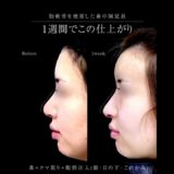 肋軟骨鼻中隔延長👃🏻　#形成外科専門医 #鼻整形 #美容整形 #垢抜け #湘南美容クリニック #肋軟骨 #鼻中隔延長 #プロテーゼ