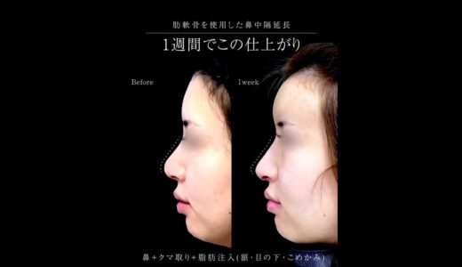肋軟骨鼻中隔延長👃🏻　#形成外科専門医 #鼻整形 #美容整形 #垢抜け #湘南美容クリニック #肋軟骨 #鼻中隔延長 #プロテーゼ