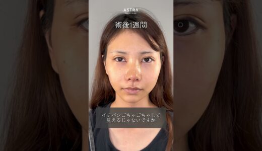 【ひろゆきに美容整形のダウンタイムについて喋らせてみた#ひろゆき#ひろゆきボイス#美容整形#ダウンタイム#astrabeautyclinic #渋谷#鼻整形#二重整形】