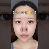 【鼻整形】過去最高まんまる鼻#shorts