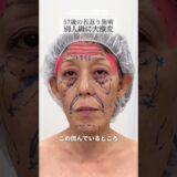 【若返り】ゲッソリ疲れ顔が若返りフル整形でどうなる？#shorts
