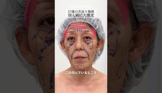 【若返り】ゲッソリ疲れ顔が若返りフル整形でどうなる？#shorts