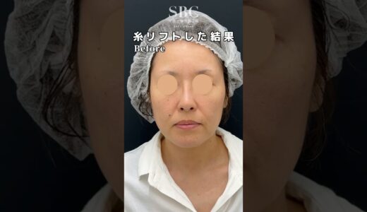 衝撃変化‼️#糸リフト #美容整形