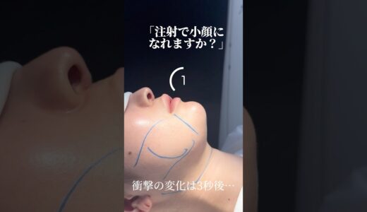 衝撃の術直後　#shorts #美容整形 #小顔