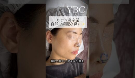 ヒアル鼻卒業✨ナチュラルで綺麗な鼻に #美容整形 #鼻整形 #ybc横浜美容外科