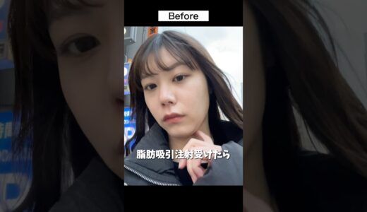 脂肪吸引注射って実際どうなの？#美容整形 #脂肪吸引注射 #ビフォーアフター #垢抜け #二重あご