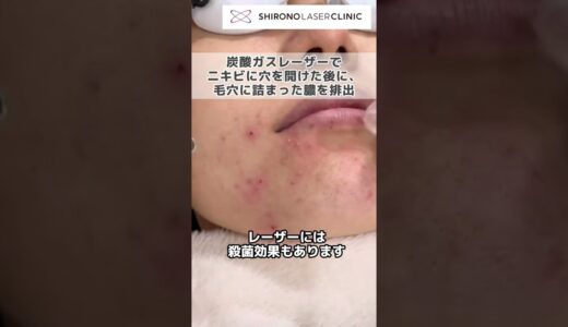 ニキビのレーザー治療  #shorts #にきび #宮本駿