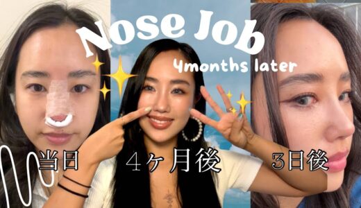 韓国で鼻整形4ヶ月後/クリニック情報/顔の変化/30代