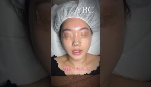 念願の鼻整形したら　#美容整形 #鼻整形#鼻尖形成
