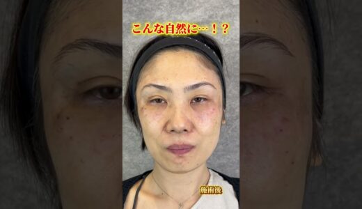 #ヒアルロン酸 #ヒアルロン酸といえば周平先生 #美容 #美容整形