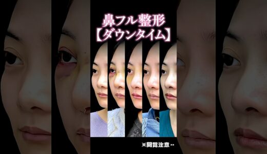 鼻フル整形経過まとめ　　#美容整形 #鼻整形 #整形 #鼻 #整形垢