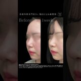 だんご鼻の改善　　#形成外科専門医 #鼻整形 #美容整形 #美容 #整形 #垢抜け #鼻尖形成 #だんご鼻 #団子鼻
