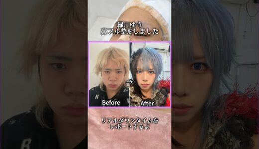 緑川ゆう鼻整形しました！ダウンタイムレポするよ！ #整形 #美容 #01gの誤算