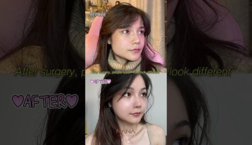 From Average to Stunning: My Plastic Surgery Transformation😮🩷