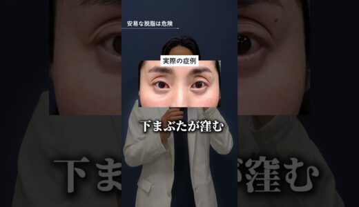 【安易な脱脂は危険です】#shorts #美容整形 #クマ治療 #クマとり #美容