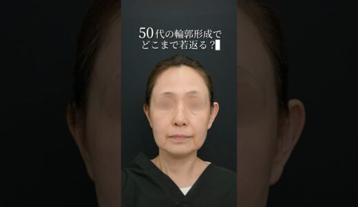 50代女性、ほんとに若返る？ #美容 #美容整形　#糸リフト #脂肪吸引