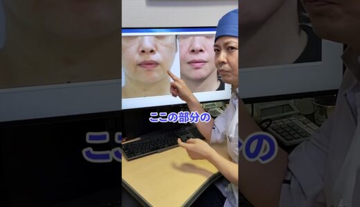 【口元が劇的に若返る】マリオネットラインを消す方法 #shorts