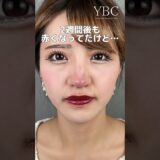 鼻整形したら【鼻尖形成/耳介軟骨移植】 #shorts