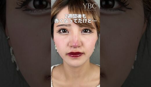 鼻整形したら【鼻尖形成/耳介軟骨移植】 #shorts