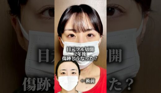 目元フル切開の経過を追ってみたよ！#美容 #美容整形 #全切開二重術 #目頭切開 #目尻切開 #タレ目形成