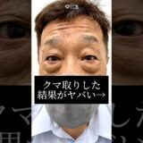 【クマ取り】クマ取りした結果がヤバい#shorts