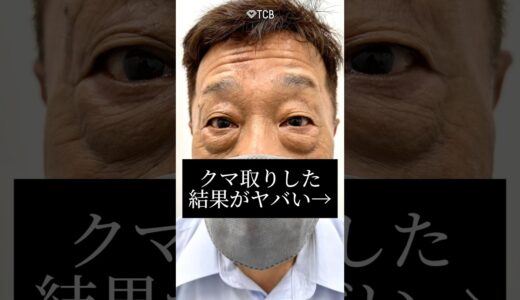 【クマ取り】クマ取りした結果がヤバい#shorts