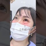【クマ取り】整形失敗！？#shorts