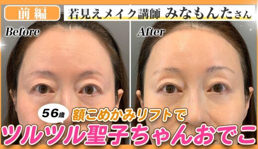 【56歳の美容整形：前編】鏡を見るたび気持ちが沈む…そんなたるみとお別れし、大成功と言われる術後に✨【#前額リフト 】