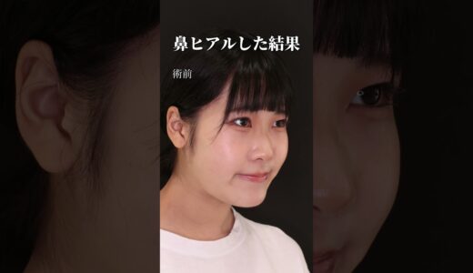 鼻ヒアルした結果…‼️#美容整形