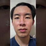 整形ビフォーアフター #整形 #美容整形 #垢抜け #垢抜け方法 #ビフォーアフター #ほくろ除去 #涙袋ヒアルロン酸 #眼瞼下垂 #二重切開 #二重埋没 #二重整形 #鼻整形 #歯列矯正 #骨切り
