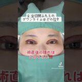 切開二重のダウンタイムはどのくらい？直後&1週間後☆