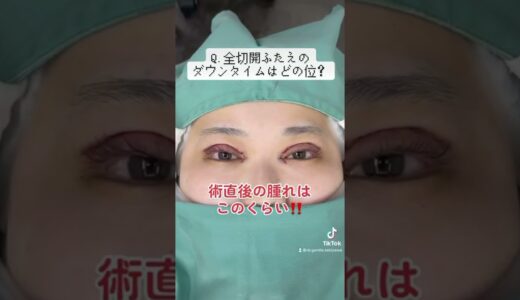 切開二重のダウンタイムはどのくらい？直後&1週間後☆