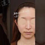 「鼻整形をしたら老けちゃった」を直す | アンチエイジングノーズ（AA Nose）#shorts #整形 #美容整形#美容クリニック #ビスポーククリニック  #アンチエイジングノーズ