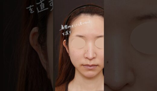 「鼻整形をしたら老けちゃった」を直す | アンチエイジングノーズ(AA Nose)#shorts #整形 #美容整形#美容クリニック #ビスポーククリニック  #アンチエイジングノーズ