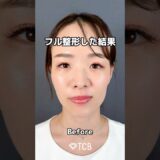 【糸リフト】フル整形した結果…#short