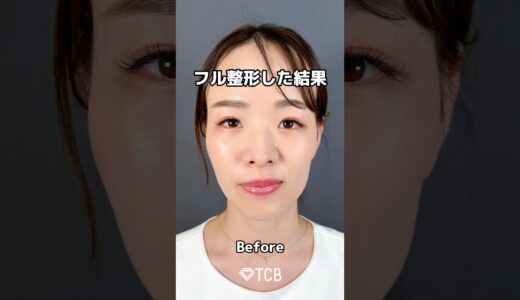 【糸リフト】フル整形した結果…#short