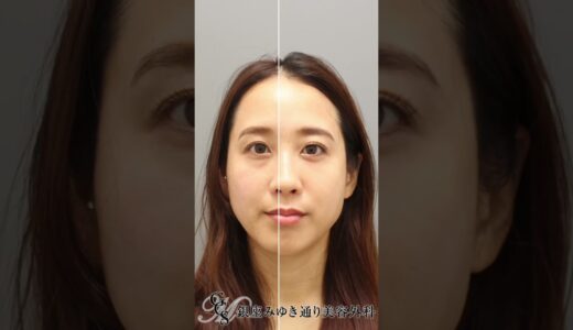 30代女性のクマ取り治療 #美容整形 #美容#目の下のたるみ取り #クマ取り