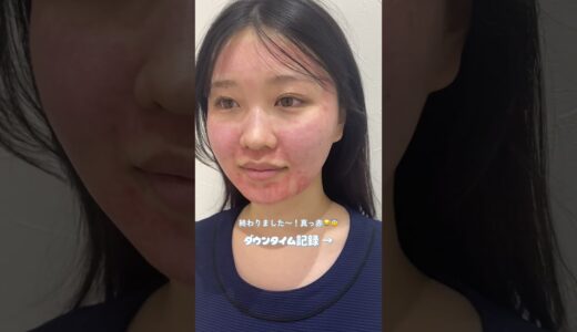 【ピコフラクショナル】ダウンタイム乗り越えればツヤツヤ肌✨スタッフ施術レポ💖