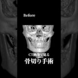 【CT公開】張り出していたエラが…#骨切り #輪郭形成 #美容整形 #shorts